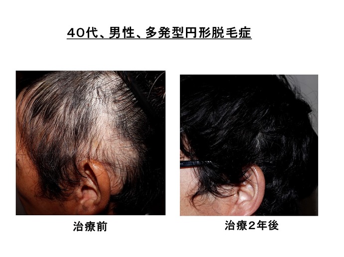 円形脱毛症　病院